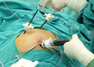 Laparoscopic Gall bladder Surgery